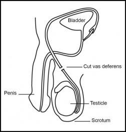 Permanent Contraceptive Methods (Sterilisation) | SHINE SA