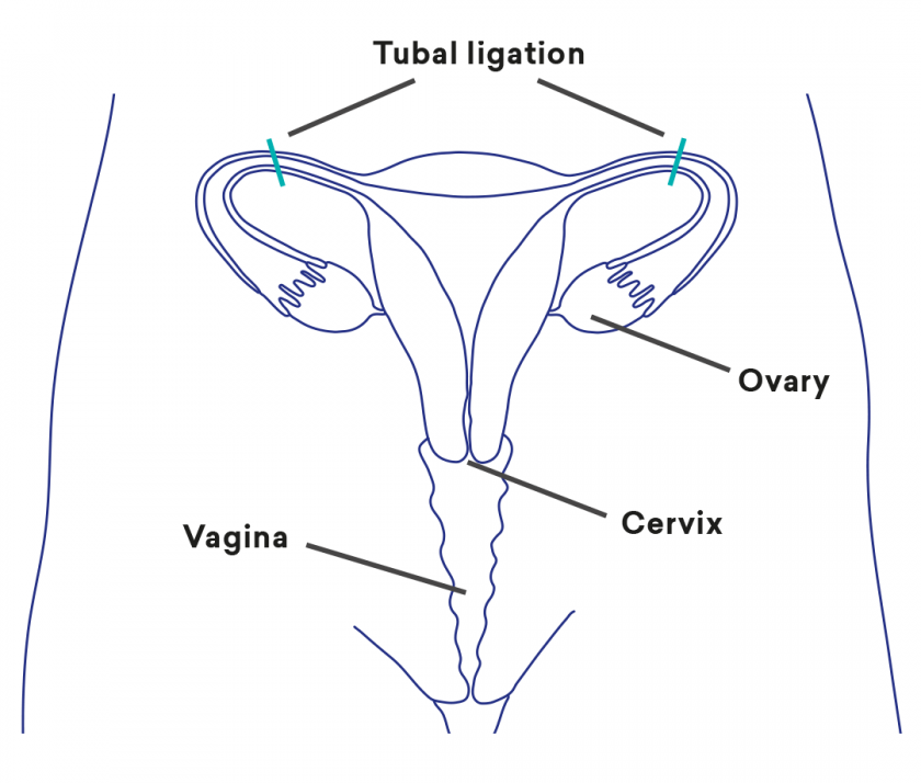 Permanent Contraceptive Methods (Sterilisation) SHINE SA